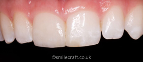 after veneer treatment